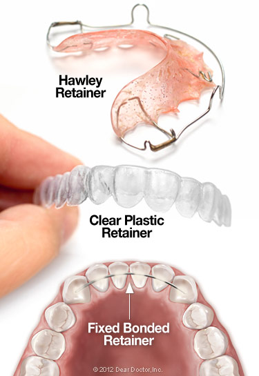 Orthodontic Retainers